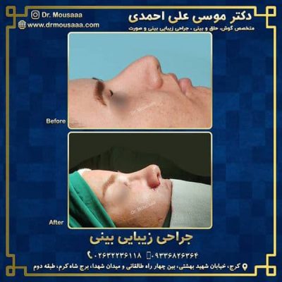 بهترین جراح بینی کرج - دکتر موسی علی احمدی